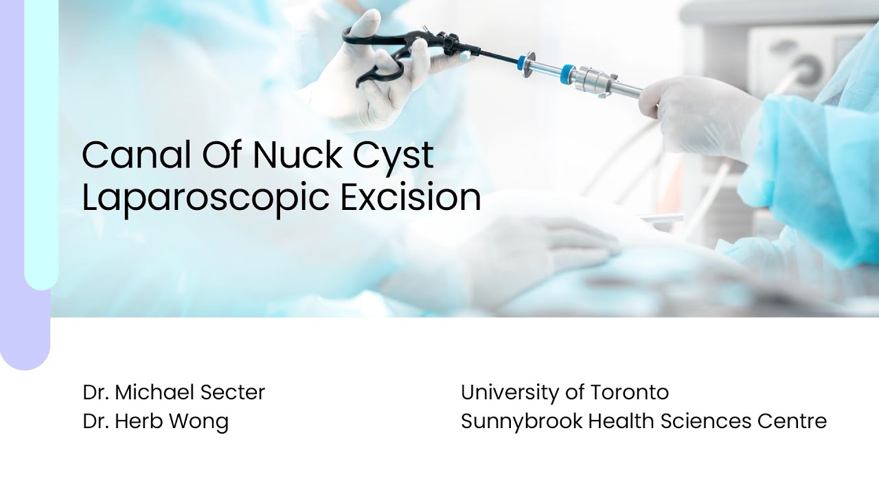 Canal Of Nuck Cyst Laparoscopic Excision YouTube Canal Of Nuck Cyst Laparoscopic Excision YouTube