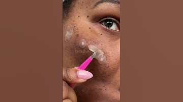 Pimple Patch Chronicles | I’m living in 🇧🇧 same acne #pimplepatch #omg