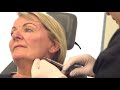 Volumetric Facelift - Non-surgical full facelift