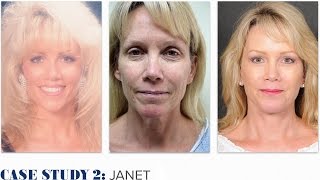 Kao Plastic Surgery  Case Study 2: Janet (Ponytail Facelift™)