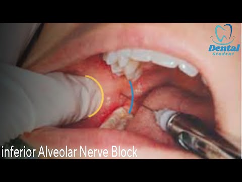Inferior alveolar nerve block & Live demo بشرح مفصل