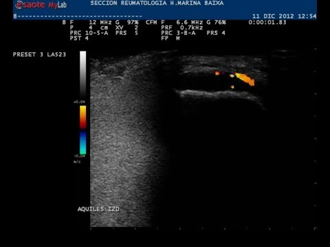 Video: Ultrasound Dalam Penilaian Enthesitis: Status Dan Perspektif