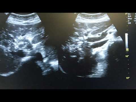 Ultrasound video showing portal venous gas embolism