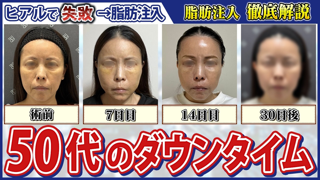 【50代必見】ヒアルで苦い経験が…脂肪注入で失敗しない自然な若返りへ【30日間ダウンタイム徹底解説】