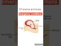 Uterine rupture during delivery | Emergency conditions during delivery #uterineruture #shorts #viral