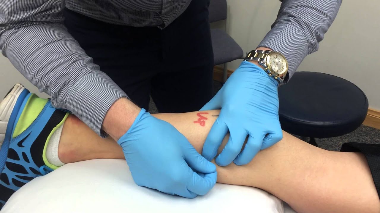Dry Needling on Left Calf 1 YouTube