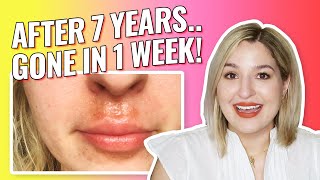 How I Cured My Eczema, Cheilitis, Contact Dermatitis Lip Rash Once & For All after 7 Years