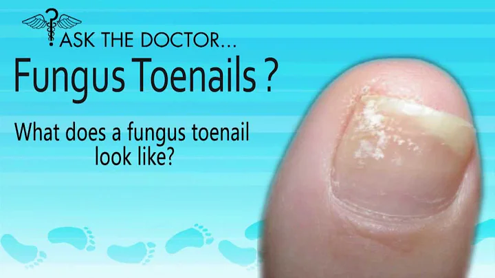 What does a Fungus Toenails Look Like? Audubon, West Chester, Newtown Square PA - Podiatrist