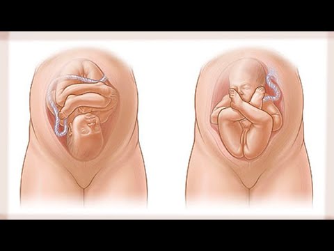 فيديو: ما هي وضعية الجنين؟