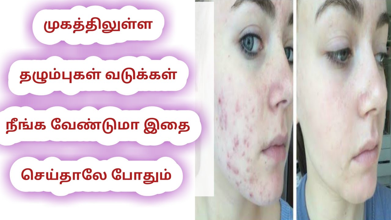 Face Acne Scars Home Remedy in Tamil Tamil Beauty tips YouTube