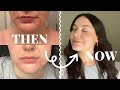 tretinoin cleared my acne in 4 months: before and after pics + tips for getting through the purge