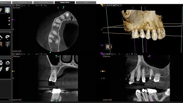 Enhancing Detail in CBCT Scans