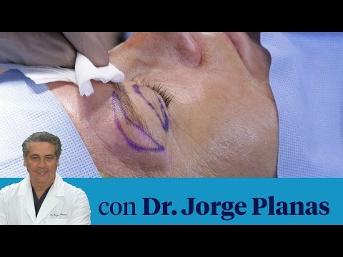 Vídeo: Cirugía Superior: Costo, Recuperación Y Detalles Del Procedimiento