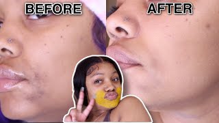 How I LIGHTENED MY ECZEMA SCARS in 7 Days with Tumeric Mask