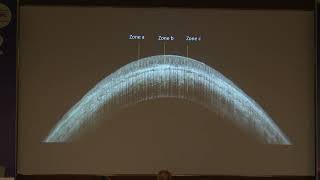 AIOC2022 FP942  Cornea II topic Spectral Domain Optical Coherence Tomography for imaging of Palisade