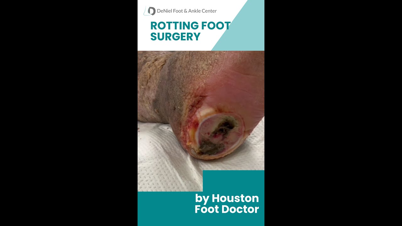 Rotting Foot Surgery by Houston Foot Doctor #footsurgeon #footdoctor #podiatrist