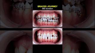 Braces journey, 960 days duration. Fix underbite and close gap teeth #braces #orthodontics #dentist