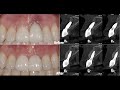 Management of an esthetically compromised implant in maxillary anterior zone gbr ctg dr alex hong
