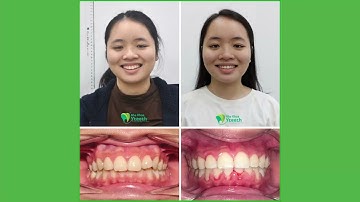 Tháo Mắc Cài Niềng Răng Đi Du Học || Bác sĩ Yến Yteeth