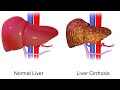 How to Heal Damaged Liver Naturally Within a Month!