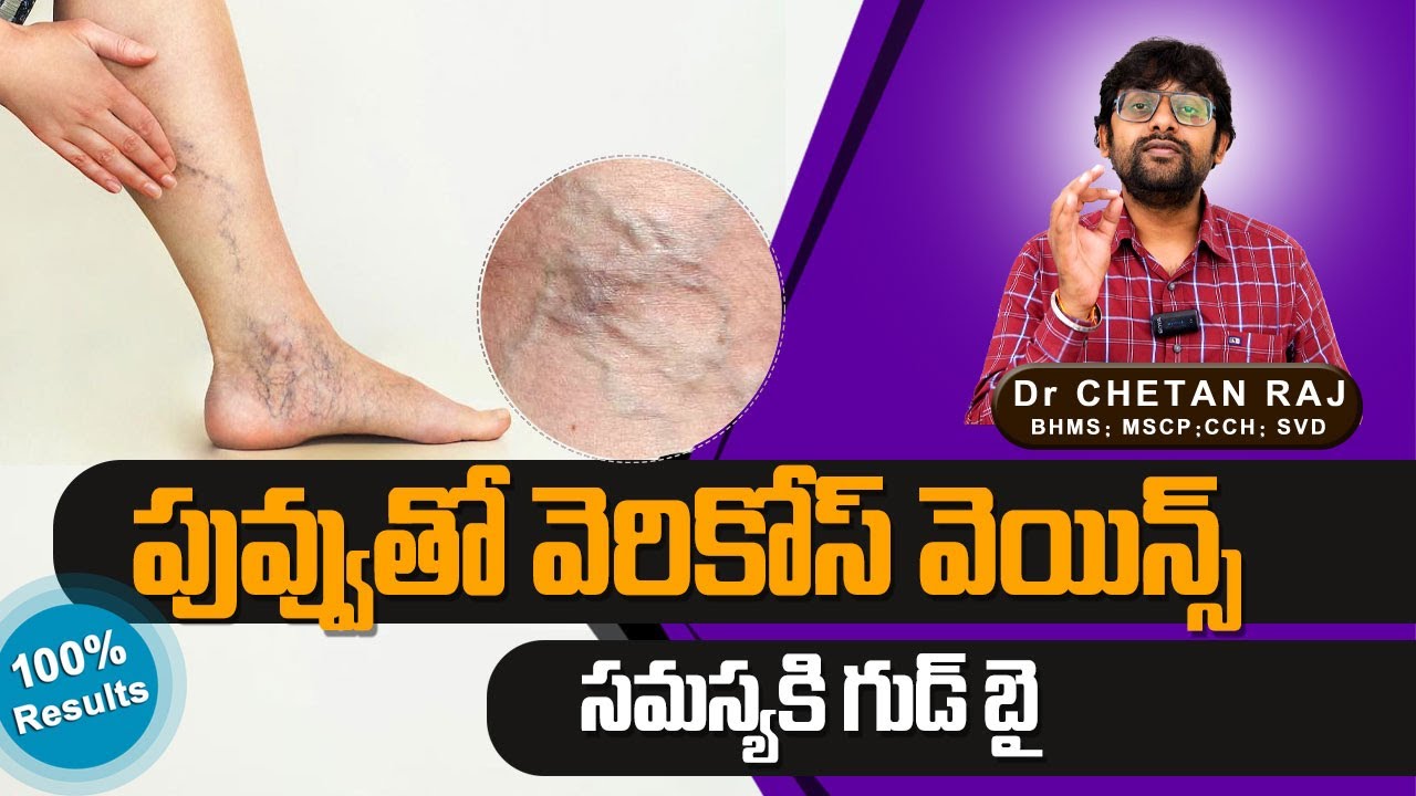 వెరికోస్ వెయిన్స్ సమస్యకి ఒకేఒక్క పువ్వుతో చెక్ పెట్టండి | Varicose Veins | Dr Chetan Raj | Nuticos