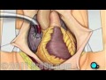 Coronary Artery Bypass Graft (CABG) Surgery PreOp® Patient Education