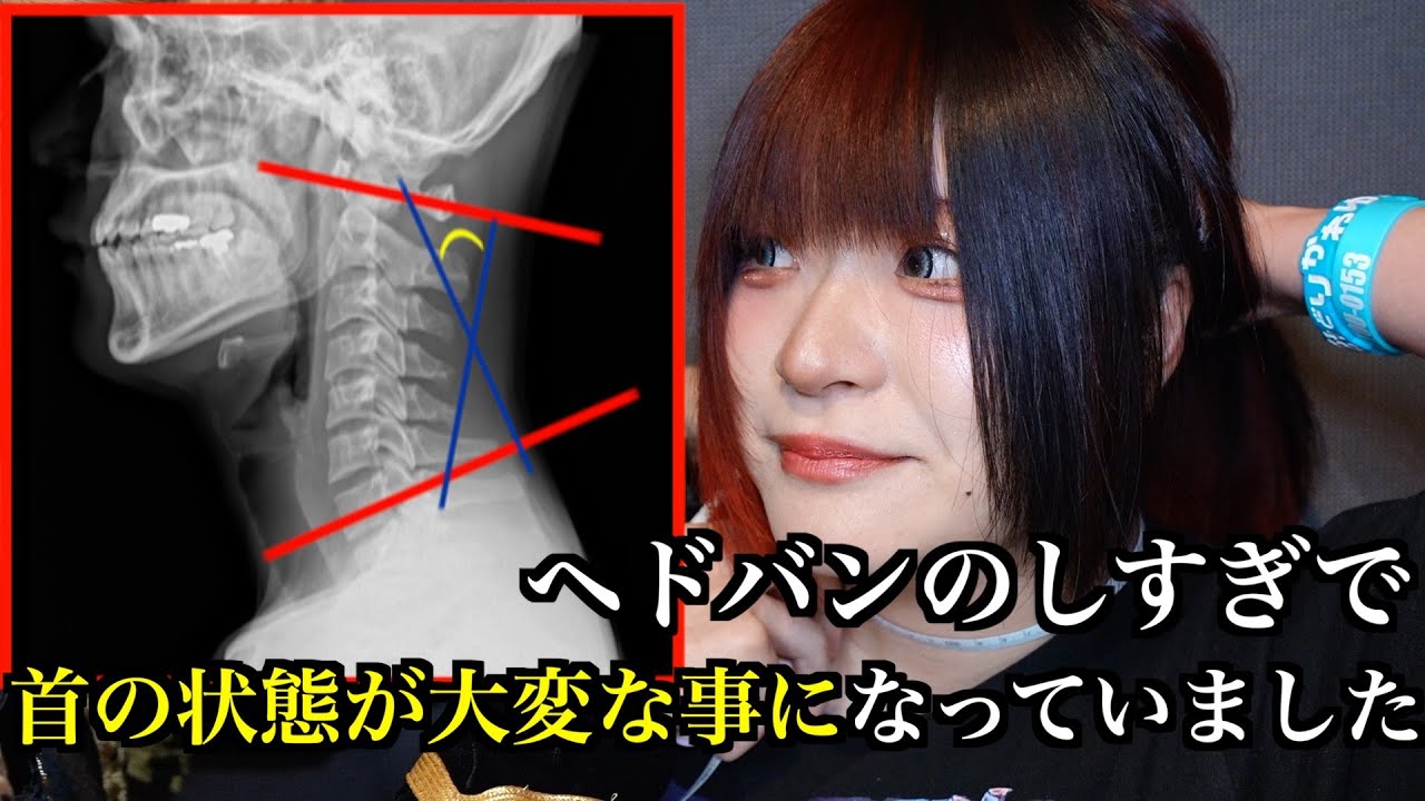 ヘドバンのしすぎで首の状態が大変な事になっていました