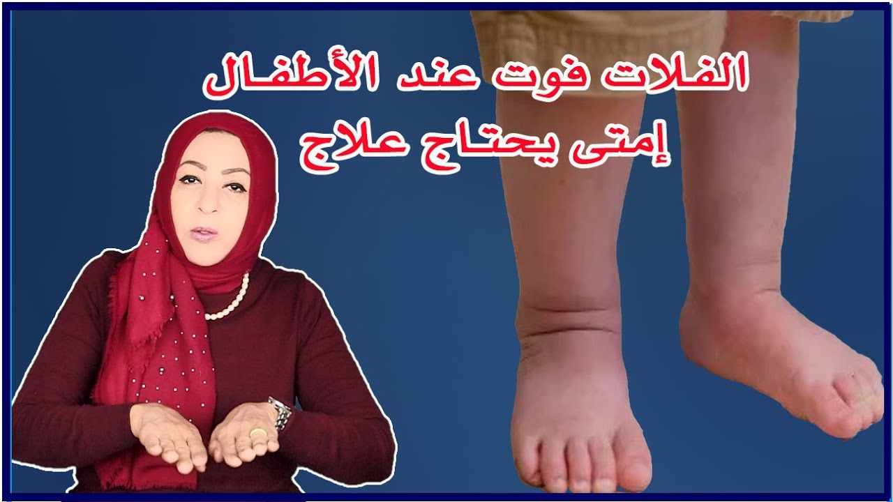 👍 الفلات فوت عند الأطفال امتى يحتاج علاج 2022 #القدم_المسطحة #الفلات_فوت #لاتنسوا_الأشتراك_بالقناة