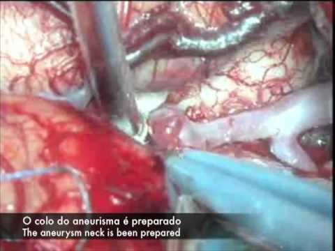 Aneurisma Cerebral - Cirurgia. Brain Aneurysm Surgery.