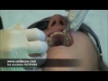 Getting an Orthodontic Expander (RPE) - Live high speed video