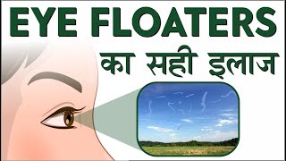Eye Floaters - Cause & Treatment | Risks & Management of Eye Floaters |आई फ्लोटर्स को कैसे ठीक करें