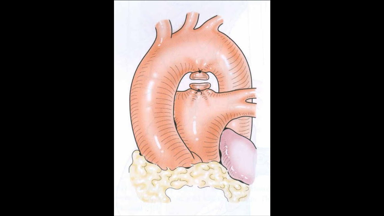 DIU 2020 Mathilde MEOT Canal artériel persistant et Autres shunts artériels