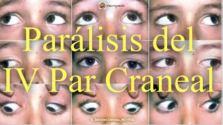 Parálisis Del Iv Par Craneal