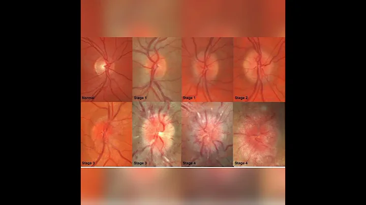 papilloedema #opthalmology #disease #eyediseases
