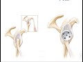 Glenoid Reconstruction Options in Shoulder Arthroplasty