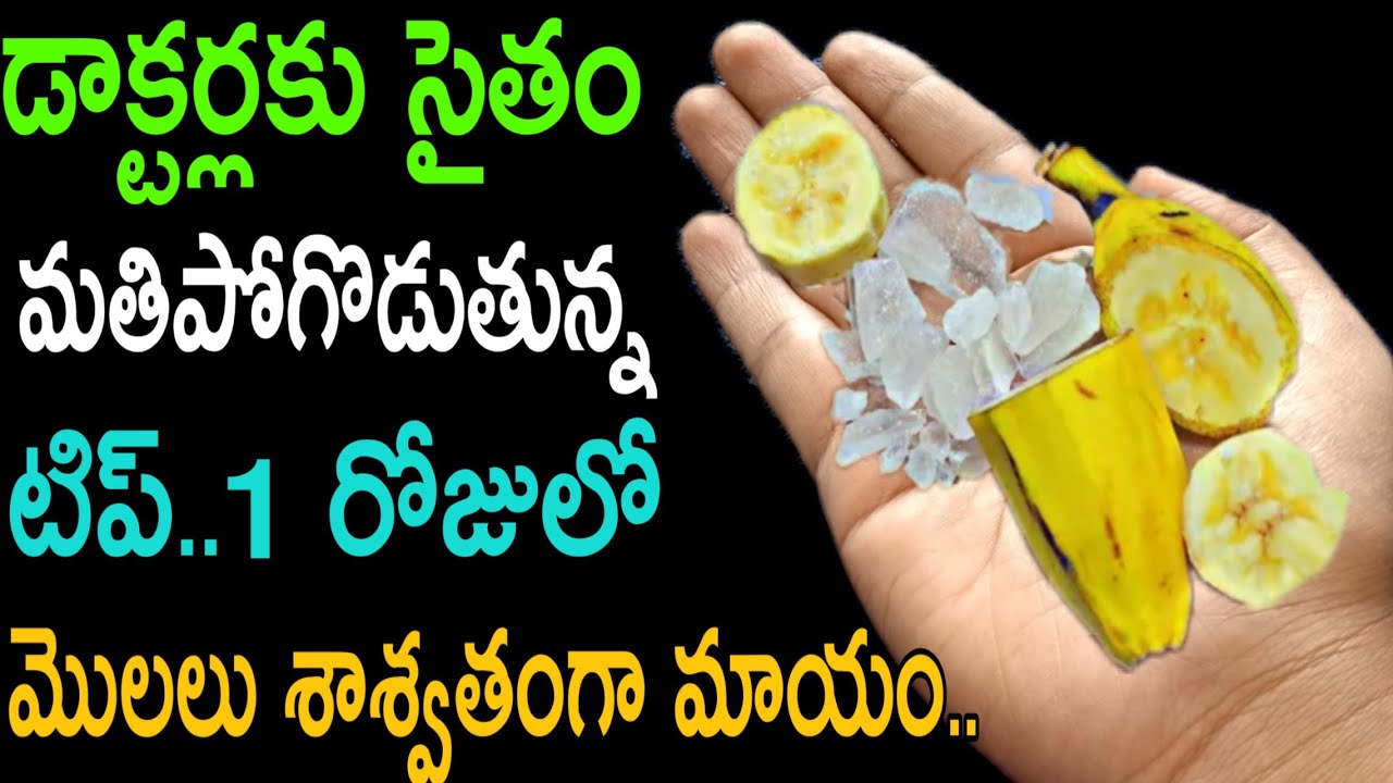 1సారి ఇలా చేస్తే చాలు ఎంతటి భయంకరమైన మొలలు,పైల్స్ శాశ్వతంగా మాయం..piles home remedies