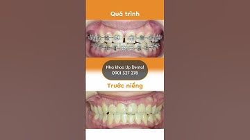 Hành trình LỘT XÁC nhờ niềng răng của Tú Anh