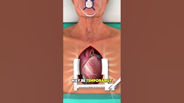 Heart Bypass Surgery (3D Animation) #heartbypasssurgery #heartbypass #heartsurgery #heartsurgery