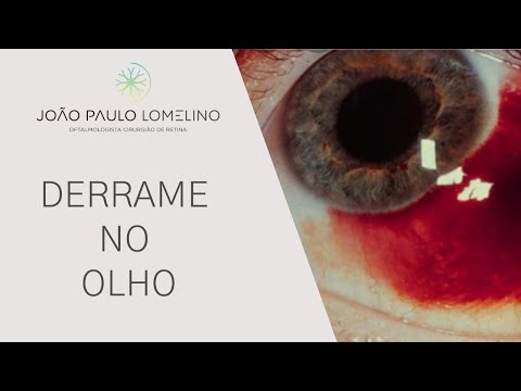 Derrame no Olho | Dr. João Paulo Lomelino