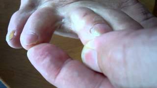 可視光線療法と光線治療