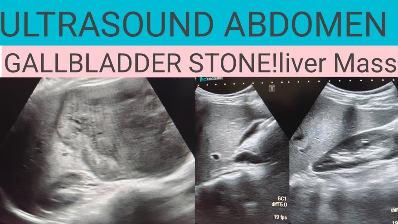 Ultrasound abdomen showing Liver Mass! Cholelithiasis! Gallbladder Stone!