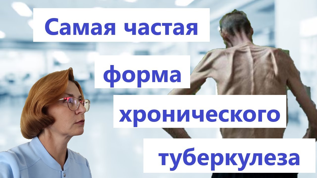Фиброзно-кавернозный туберкулеза