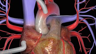 Graft di Bypass Aortocoronarico (CABG)