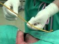 Bougie-Aided Cricothyrotomy by Darren Braude