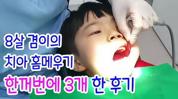 8살 겸이의 충치 예방을 위한 치아 홈메우기(치아 실란트) 한꺼번에 3개 하고 온 후기 [아이킥TV]