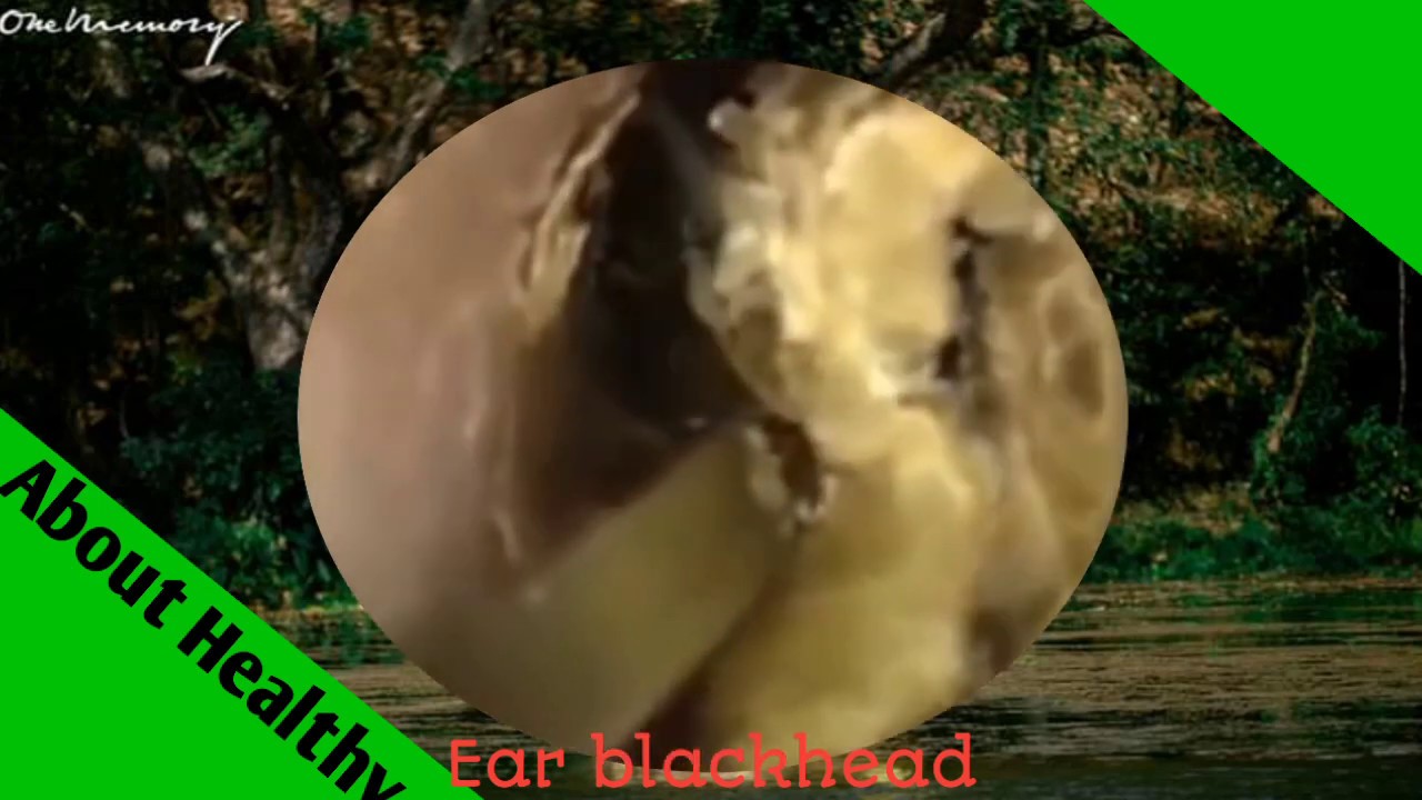 Ear wax removal ( Get rid of ear wax ) #กำจัดขี้หู/ part 07 - YouTube