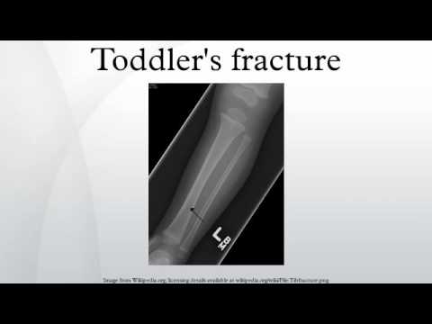 Toddler&rsquo;s fracture