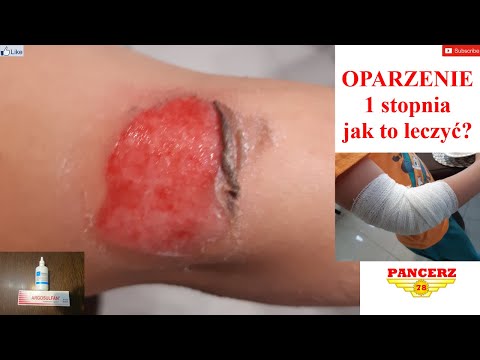 Wideo: Jak leczyć oparzenie (ze zdjęciami)