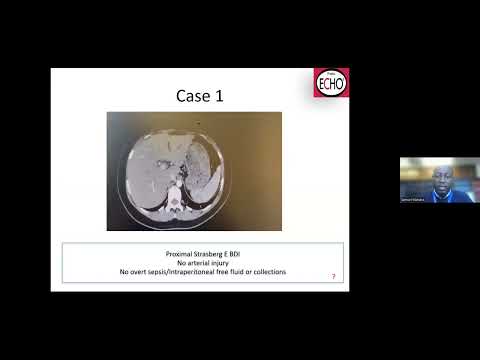 “Endoscopic Management of Bile Duct Injuries" - Prof Bernon & Dr S Wanjara