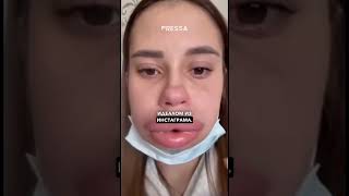 Девушка попыталась «сдуть» губы — и едва не лишилась их навсегда! После процедуры, которая должна